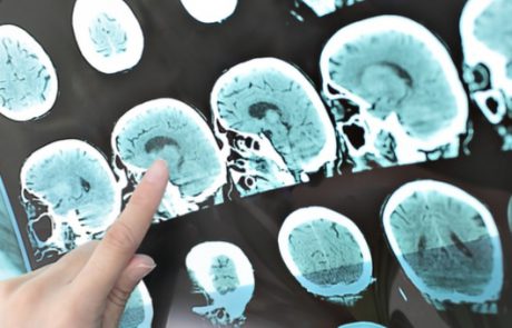 בדיקת ברזל מהפכנית במוח עשויה לשנות טיפול בטרשת נפוצה