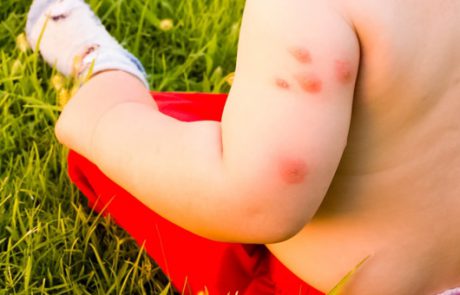 קדחת מערב הנילוס – כך תפחיתו את הסיכוי בהידבקות